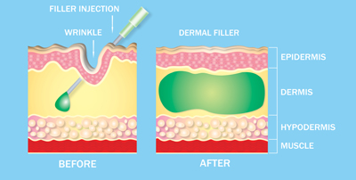 Globe town Dermal fillers near me