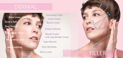 Juvederm dermal fillers Mile end